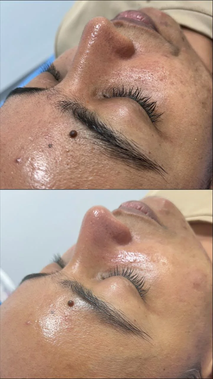 Resultado inmediato de una sesión de cuidado facial